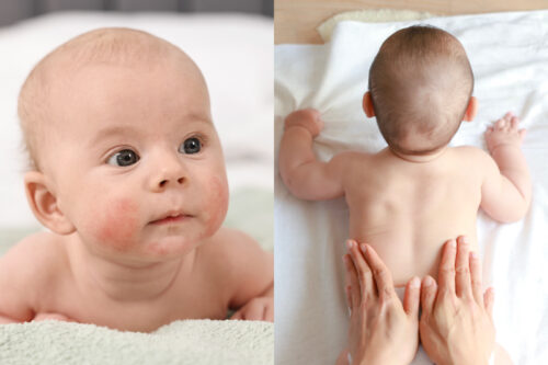 嬰兒奶癬全攻略｜BB奶癬=濕疹？成因、症狀、預防、護理方法＋嬰幼兒潤膚霜推薦 家長必讀！【附父母常見疑問】